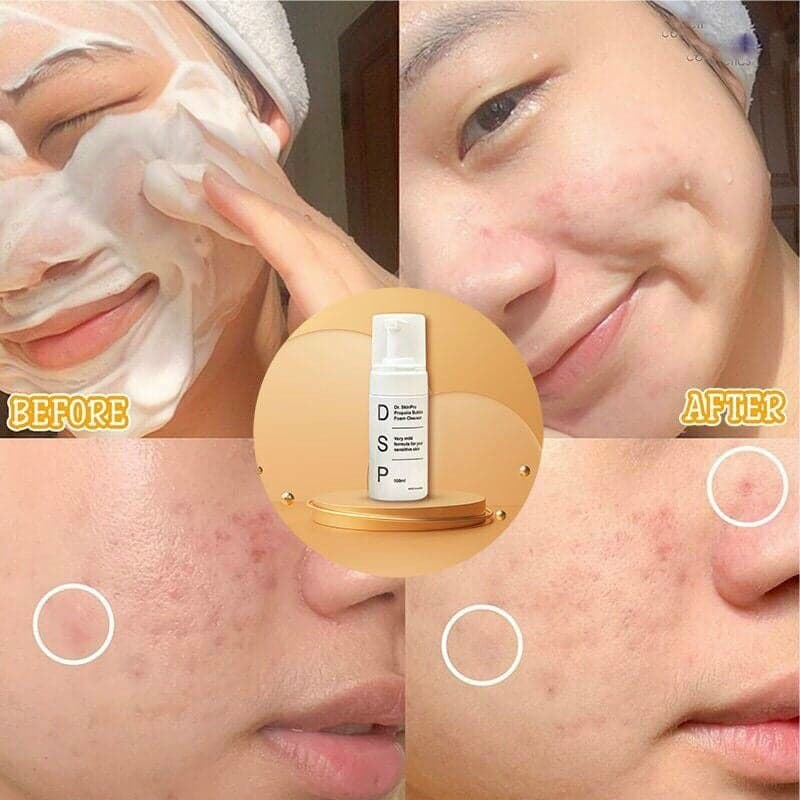 Sữa Rửa Mặt Trị Mụn Dr.SkinPro ảnh 5